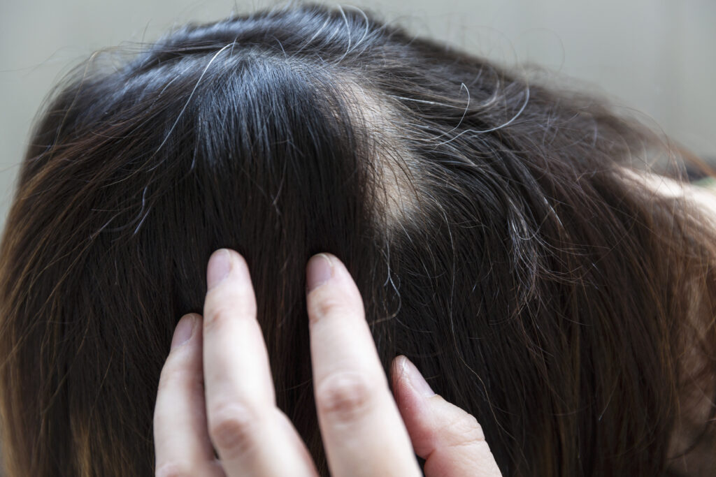 alopecia areata control del estrés
